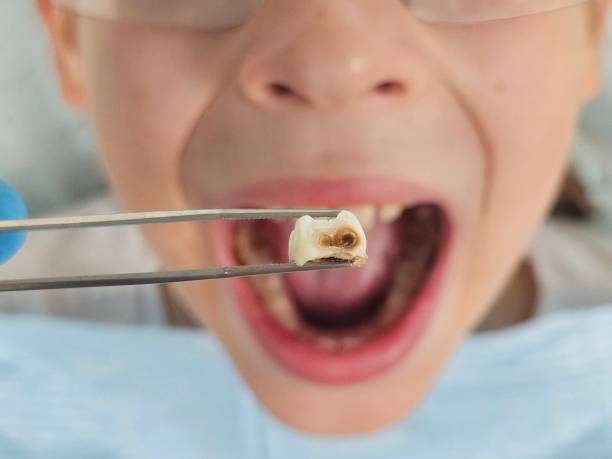 Best Emergency Dental Care for Broken or Chipped Teeth in Woodstock, IL