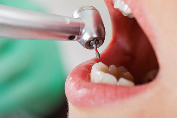 Best Emergency Dental Care for Broken or Chipped Teeth in Woodstock, IL